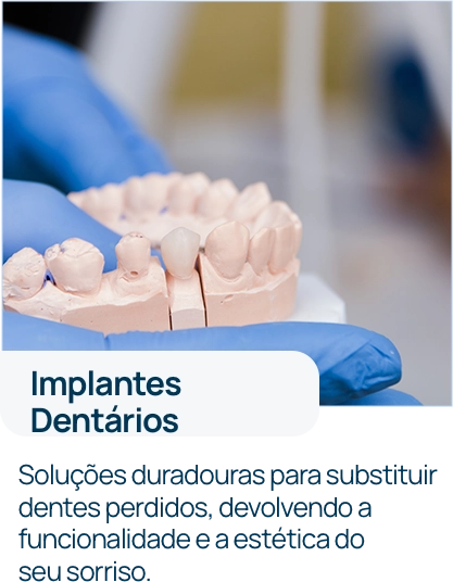 Implantes Dentários_